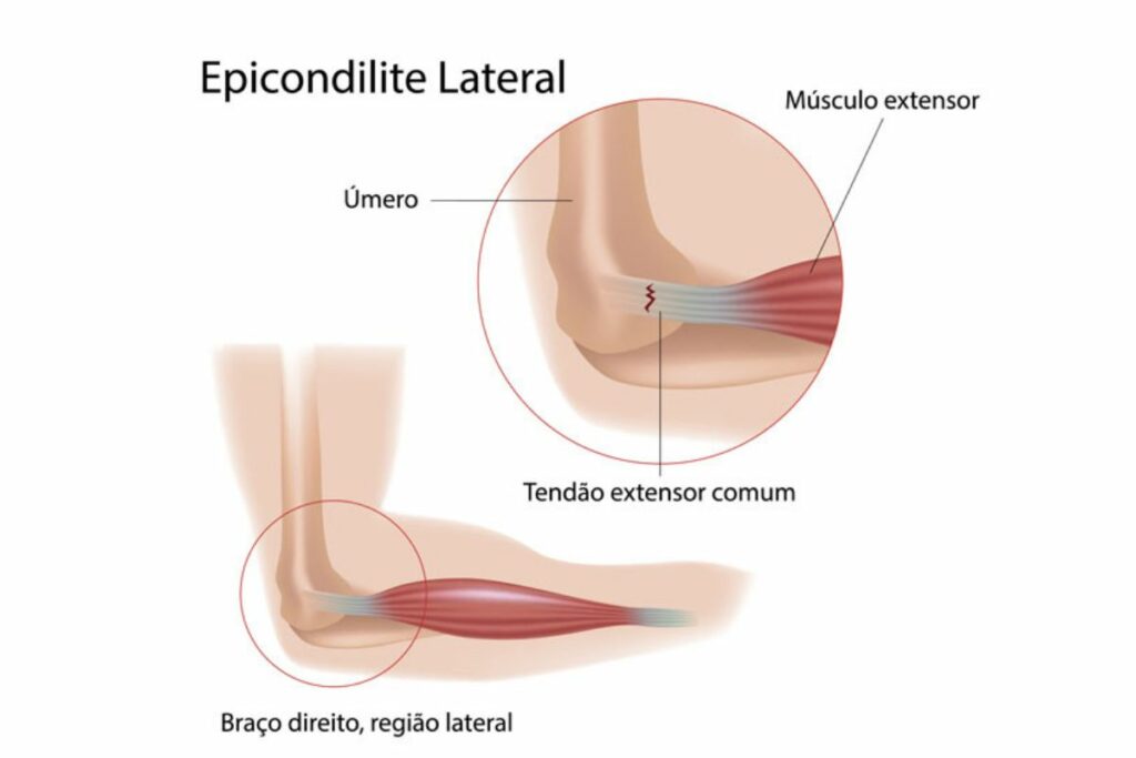 relato de uso de hand grip epicondilite